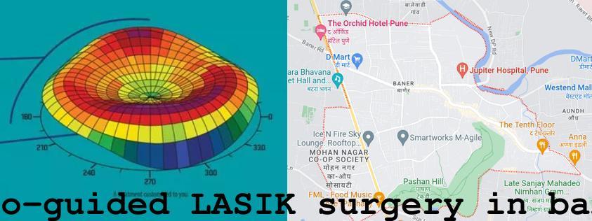 Topo-guided LASIK surgery in Baner